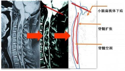 脊髓空洞的诊断要点是什么,为您解答脊髓空洞症的症状是什么