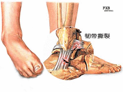 跑步后腿疼脚疼是怎么回事,跑步后腿脚痛如何缓解