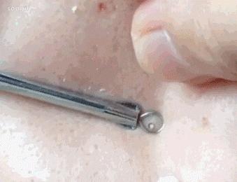 鼻子起痘都能挤出很多白色油脂,鼻子白色的痘痘挤出来有痘坑吗