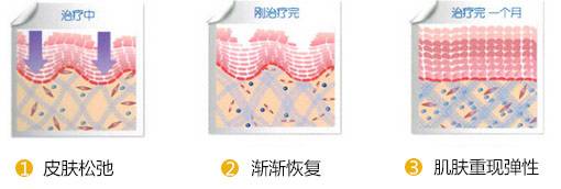 注射除皱玻尿酸和除皱针要怎么选,注射除皱和填充