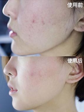 美容针美容的误区,为美而整容最后付出的代价