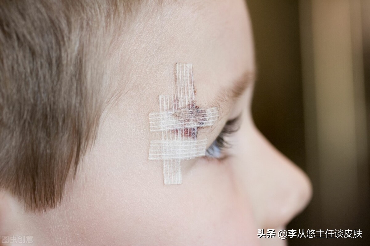 皮肤受伤后会得白癜风,皮肤损伤诱发白癜风的风险大吗