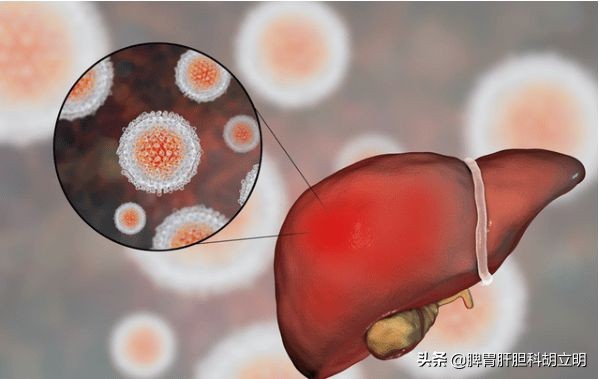 肝硬化患者如何改善肝硬化,如何治疗肝硬化效果最好