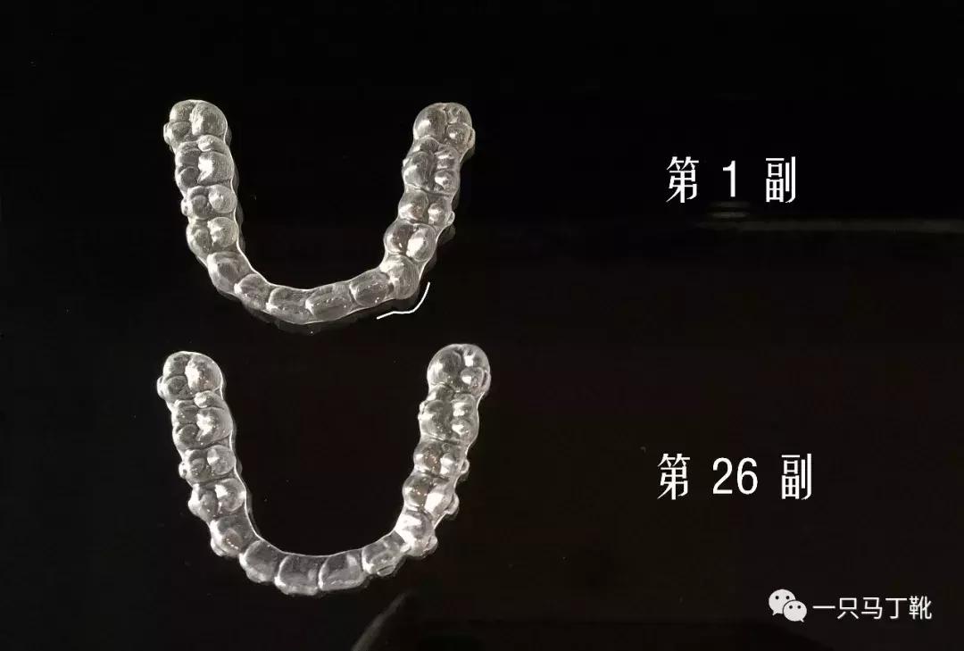 整牙一年半,这次重点说说整牙给我带来的小困扰