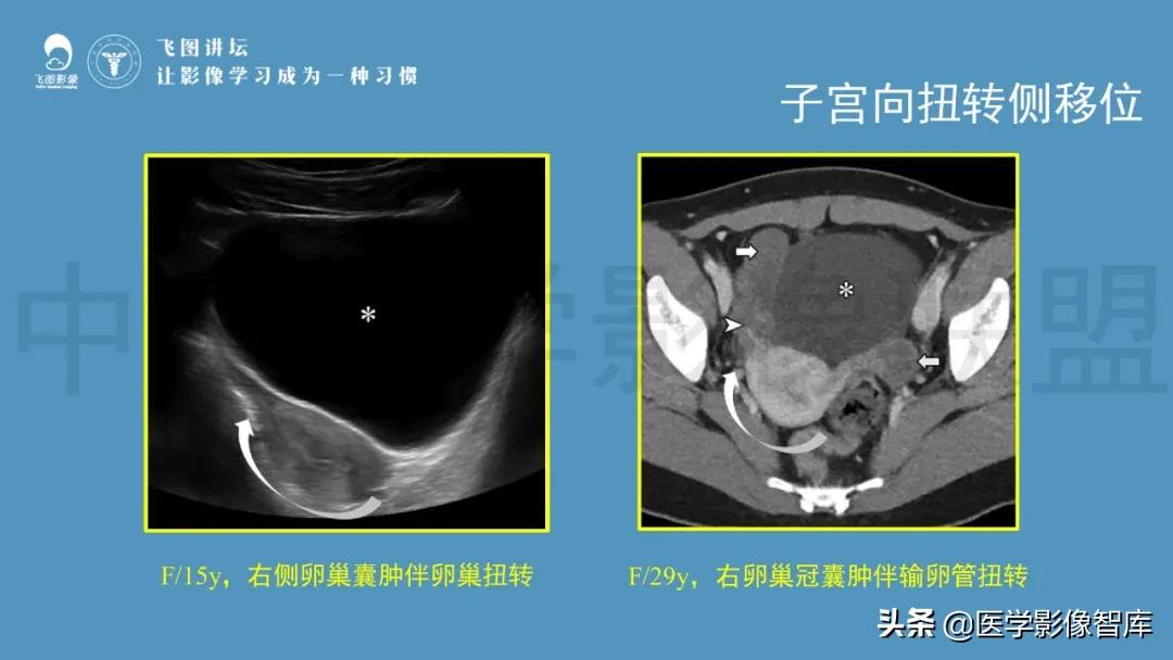 子宫解剖结构输卵管和卵巢位置,子宫附件ct影像学正常解剖表现