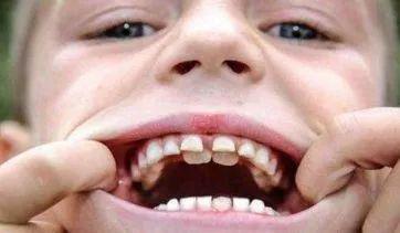 儿童双排牙是自然掉还是拔,孩子刚长了双排牙医生建议别拔