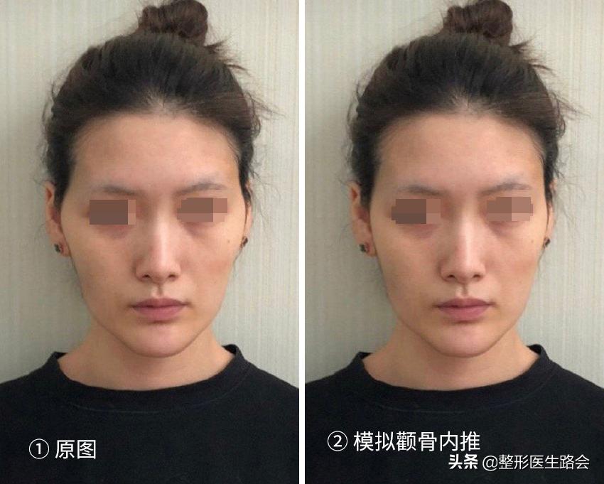 太阳穴凹陷颧骨高适合留中分吗,太阳穴凹颧骨高用什么哑光高光好