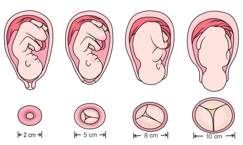 宫口开十指后如何超快顺产,开十指顺产多长时间