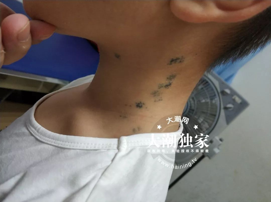 男童脖子上的针眼,10岁男孩颈部有密密麻麻红点