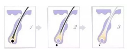 ipl光子脱毛仪和冰点脱毛仪的区别,光子脱毛和激光脱毛冰点脱毛区别