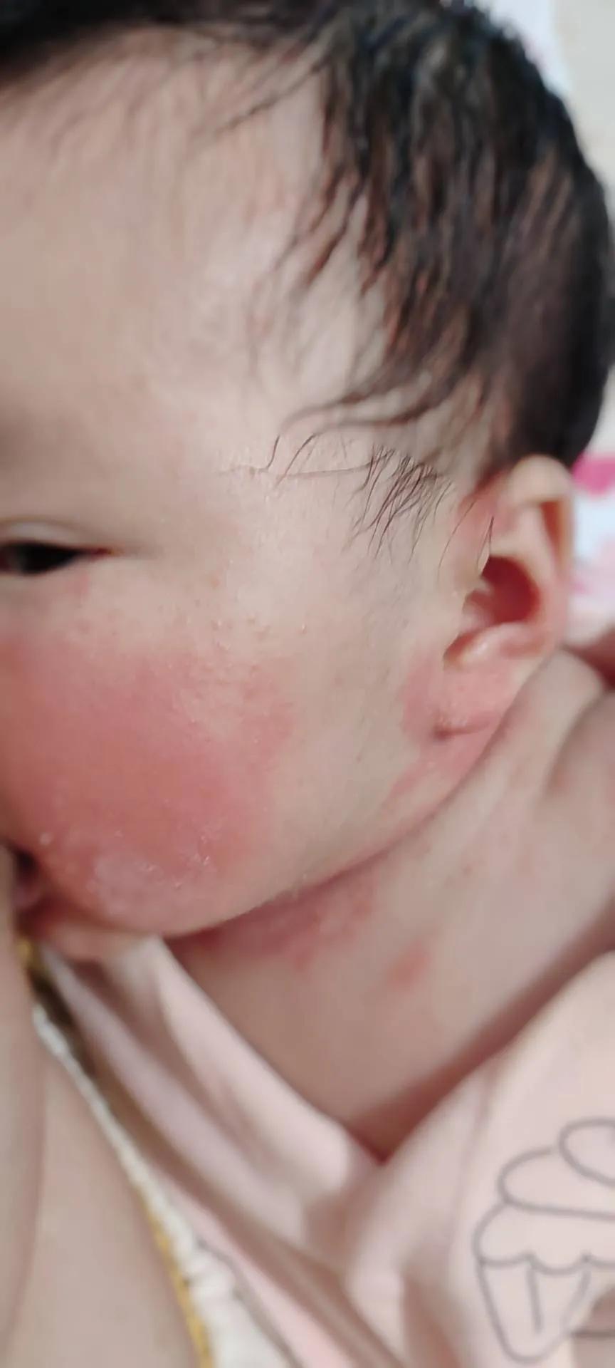 宝宝大作战8-9,宝宝湿疹大作战