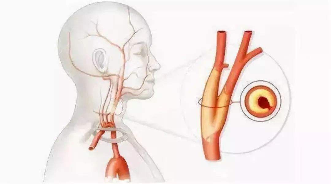 血管狭窄用药可以改善吗,老人血管狭窄吃什么药疏通