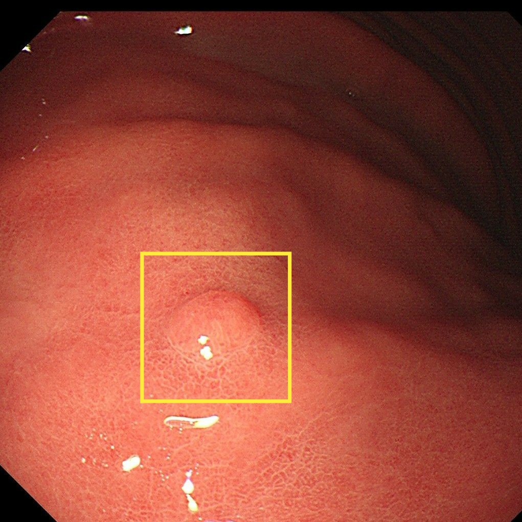 胃药吃久了会产生抗药性吗,胃药吃多了会长息肉吗