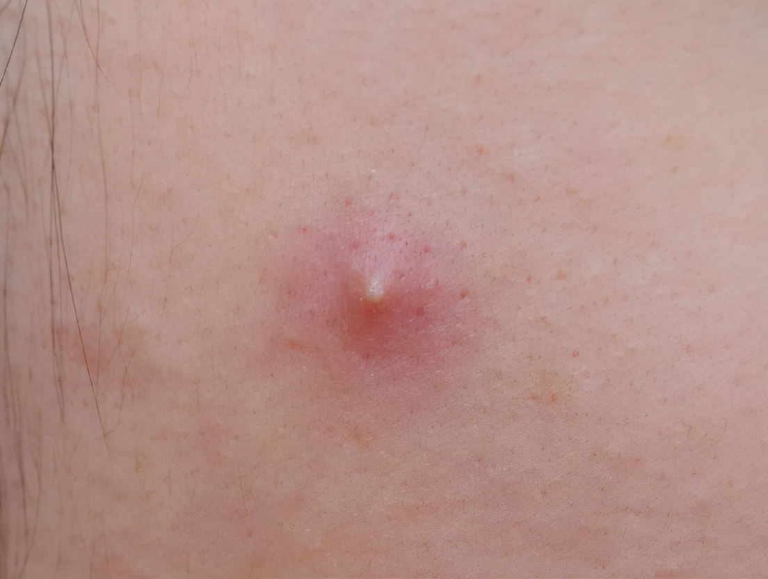 两块钱的红霉素软膏有什么用途,2块钱的红霉素软膏能祛斑吗