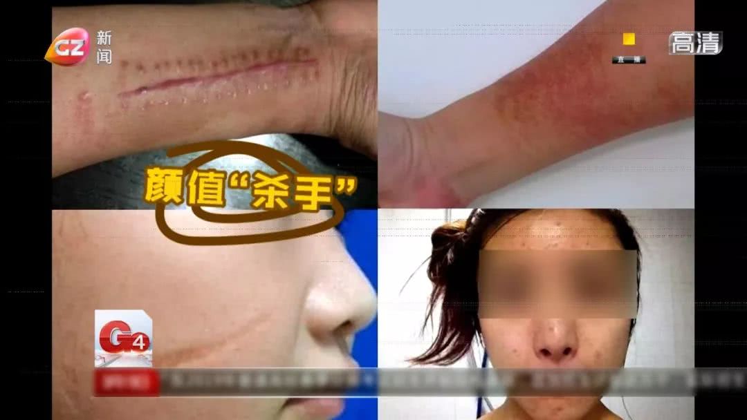 亲测有效祛疤产品,祛疤最快的神器