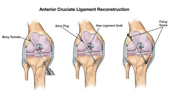 前交叉韧带重建术后膝盖怎么松解,膝关节韧带术后纤维化怎么办