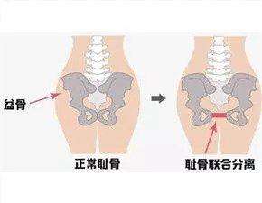 孕期耻骨疼乳房疼,孕期耻骨疼一般会疼多久