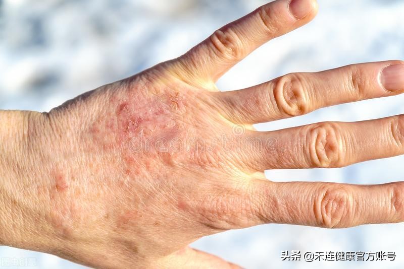 身上出现小红点是肝出现问题了吗,身上有小红点跟肝有关系吗