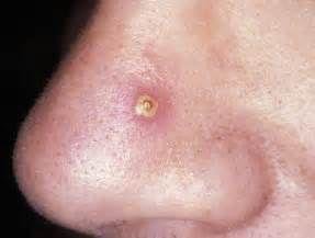 毛囊炎、疖和疖病的发病机制、临床表现和治疗原则