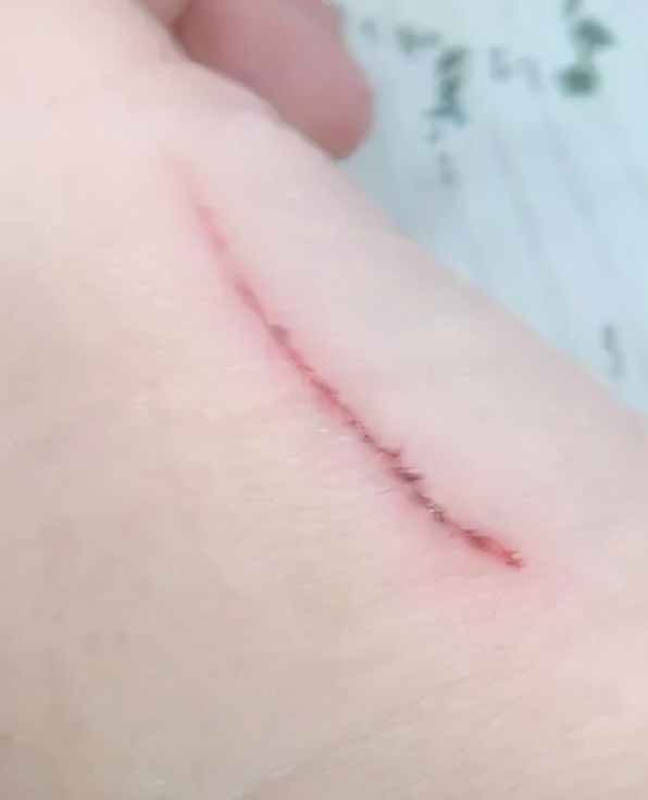 被马蜂叮咬后怎样处理,小磕小碰刮擦自己处理