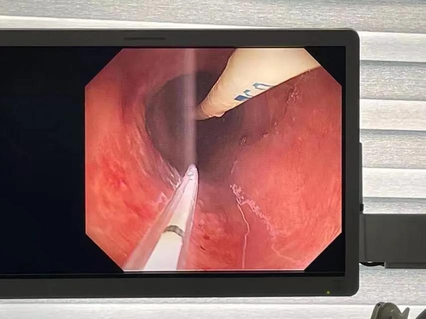 介入治疗食道癌成功案例,最新前沿治疗肿瘤技术