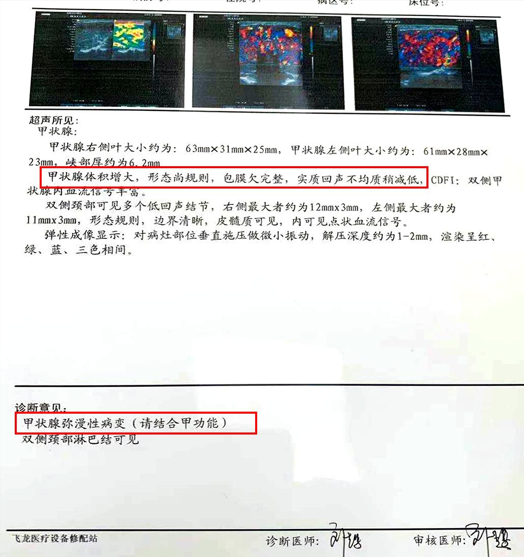 甲亢治愈的真实例子,甲亢用药过量导致甲减脖子粗