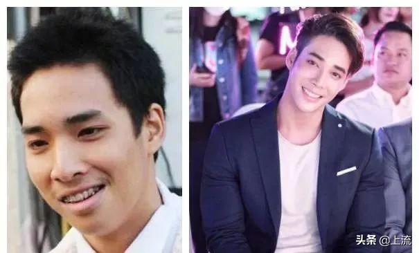 泰国流行戴牙套,泰国最近很火的牙套