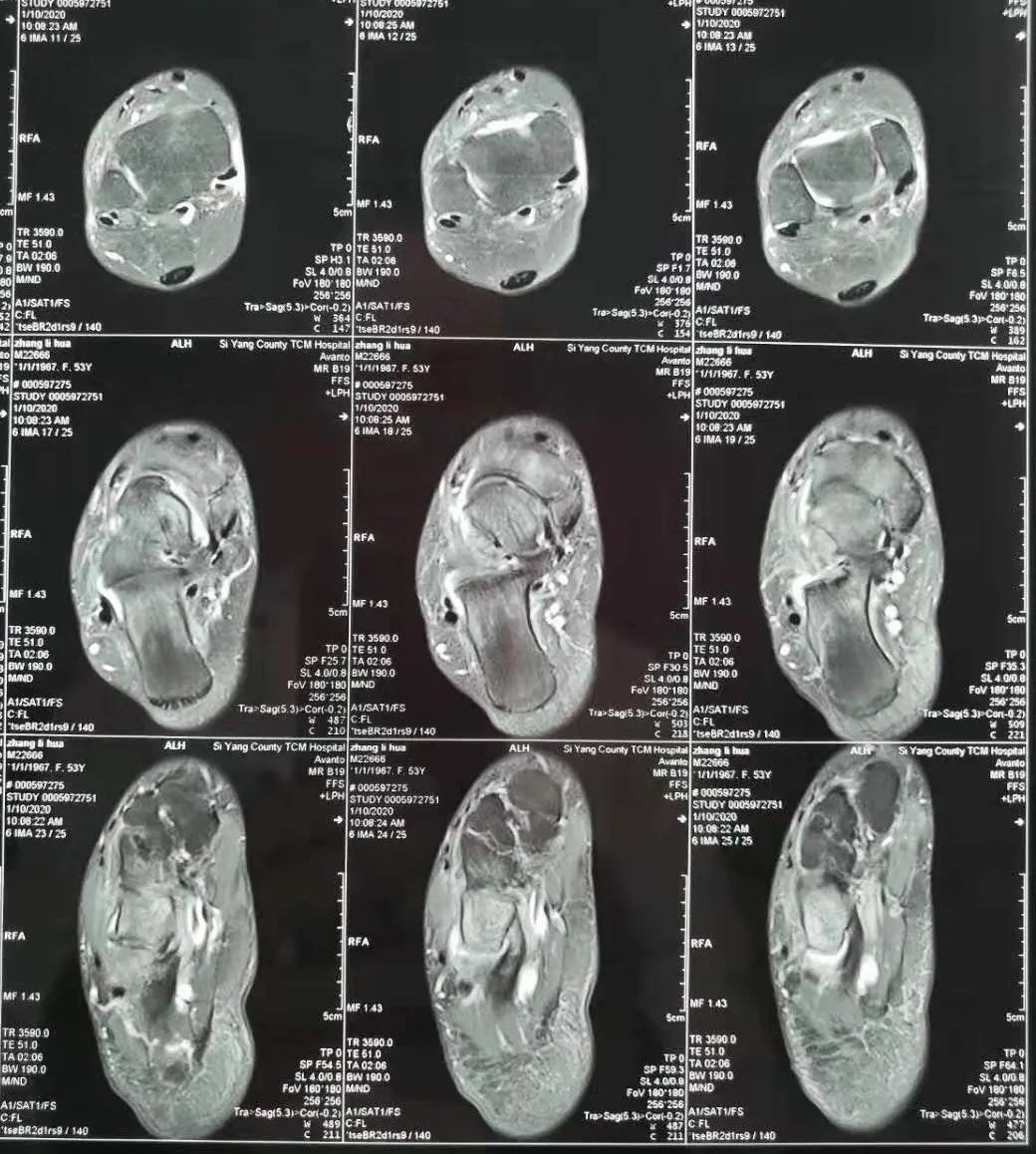 泗阳治疗脚崴的地方,泗阳哪家医院治疗脚扭伤