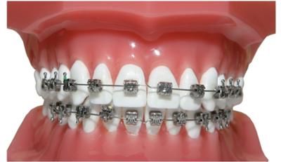 40岁戴牙套可以矫正牙齿吗,哪种牙套矫正牙齿效果最好