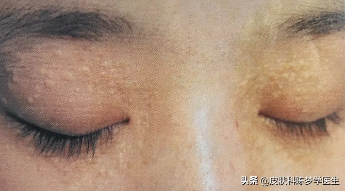 脖子上长了几个针尖大的肉球,脖子上长了丝状疣是感染了hpv吗