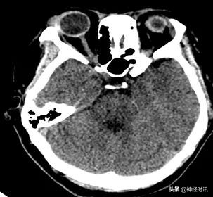 一例脑干出血的个案护理,外伤性脑干出血保守治疗成功案例