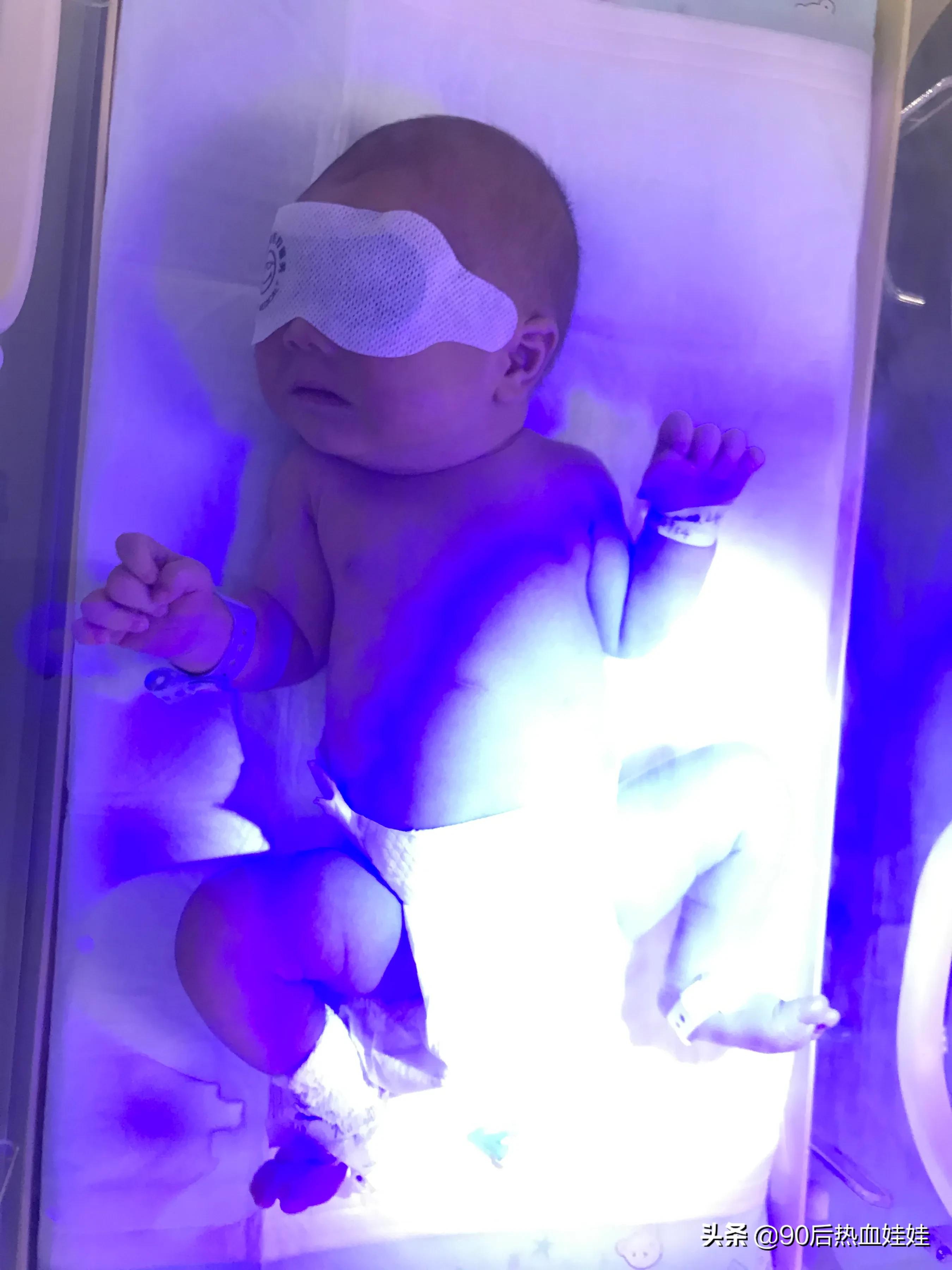 新生儿出黄疸要做的三件事,黄疸的相关知识和最新进展