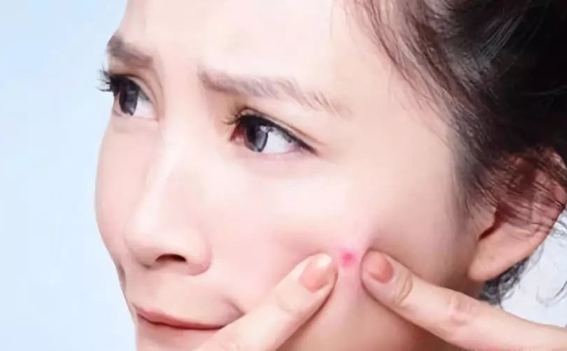 真实有效的几款祛痘印神器,祛痘印最有效的方法排名