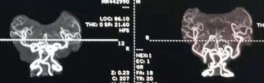 头发卷曲是毛囊受伤吗,头发卷毛是基因变异吗