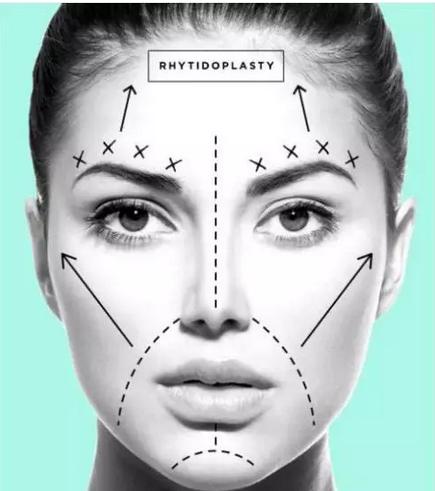小切口拉皮除皱术适合额头除皱吗,额头缩小大拉皮手术恢复过程