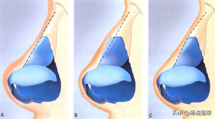 捏鼻梁神器变高真的吗,徒手捏鼻梁是真的吗