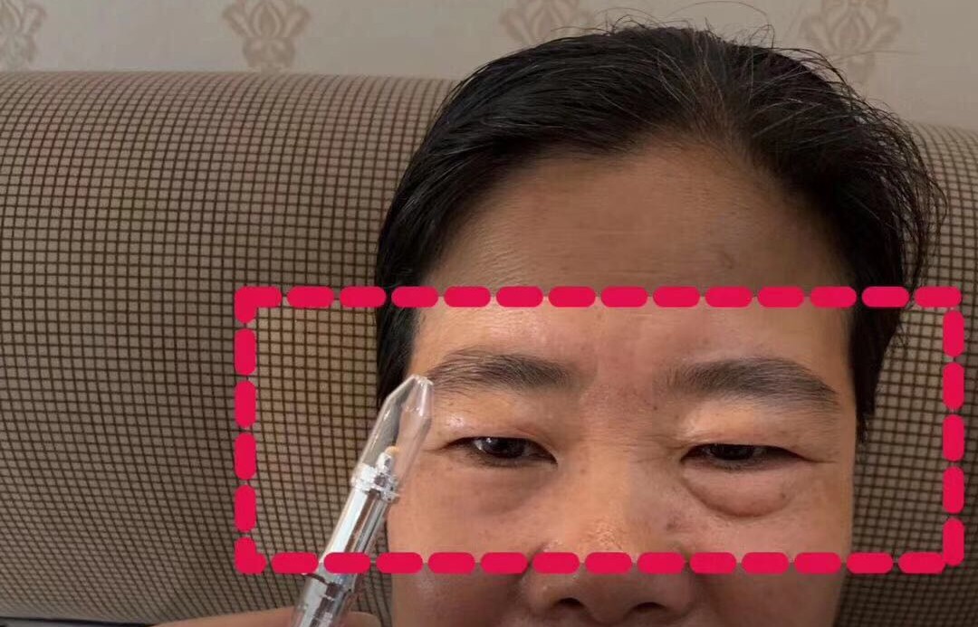 眼袋救星来了,医生推荐眼袋救星