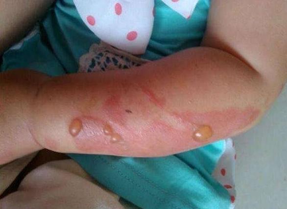 当孩子被烫伤时，用这5个步骤缓解