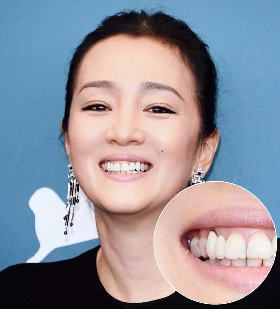 冷光美白牙齿危害亲身经历,牙齿美白科普篇