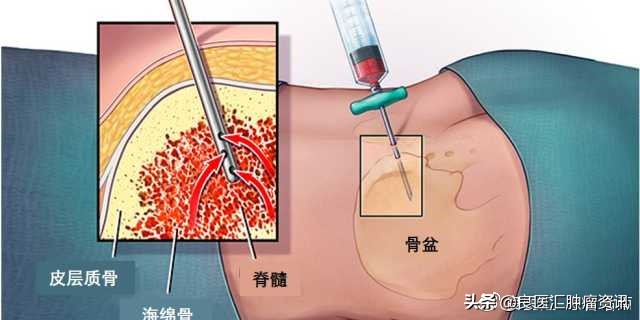 穿刺结束有点疼痛,穿刺抽血后筋痛