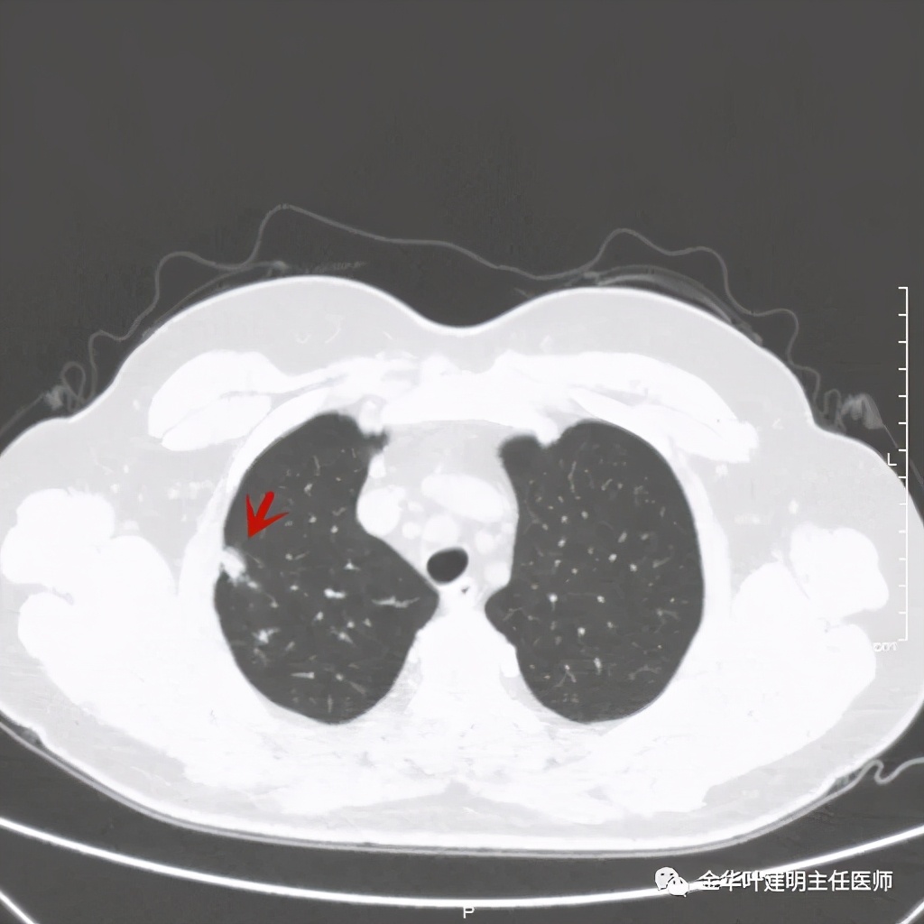 右上肺结节灶一般是什么癌,右上肺恶性肿瘤是肺癌吗
