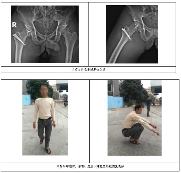 pipkin骨折,pipkin的视频