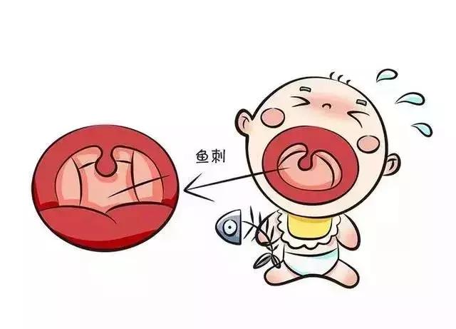 卡鱼刺在喉咙吃醋有用吗,吃鱼刺卡到的急救方法