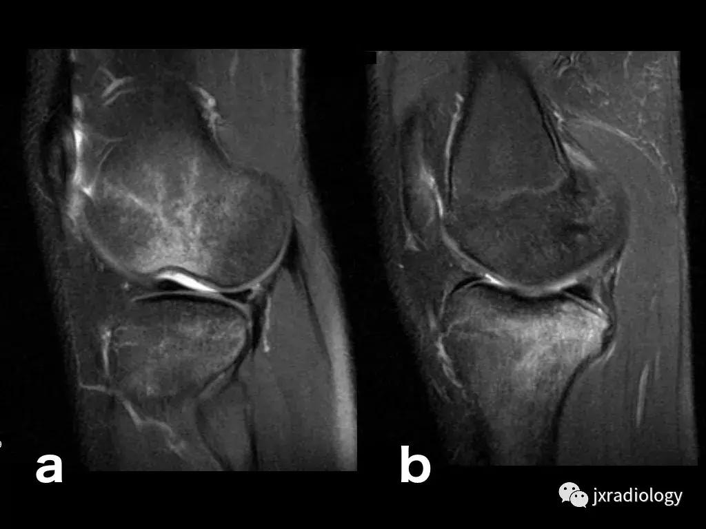 磁共振天天诊断骨髓水肿，但您知道原因吗？
