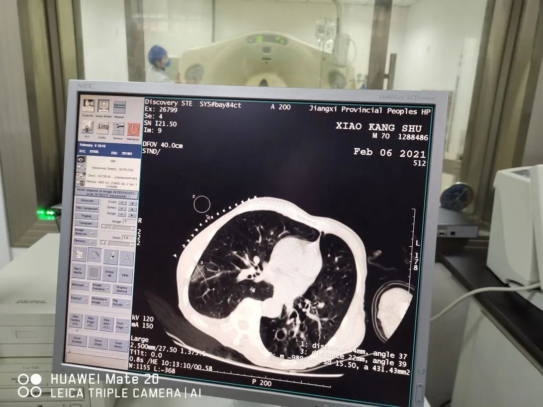 江西省人民医院心血管射频消融,多发肺腺癌消融