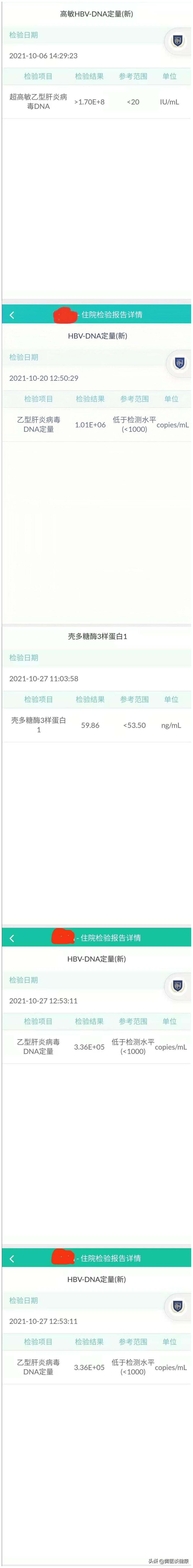 替诺福韦耐药肝功能正常,替诺福韦抗病毒后胆红素高怎么办