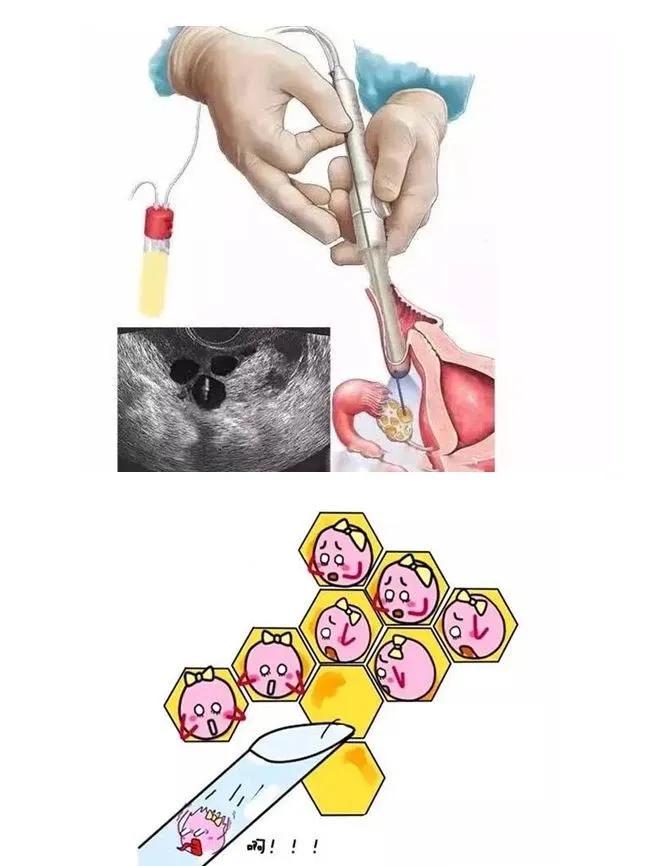 三分钟了解试管婴儿全流程,试管婴儿备孕前三个月注意事项