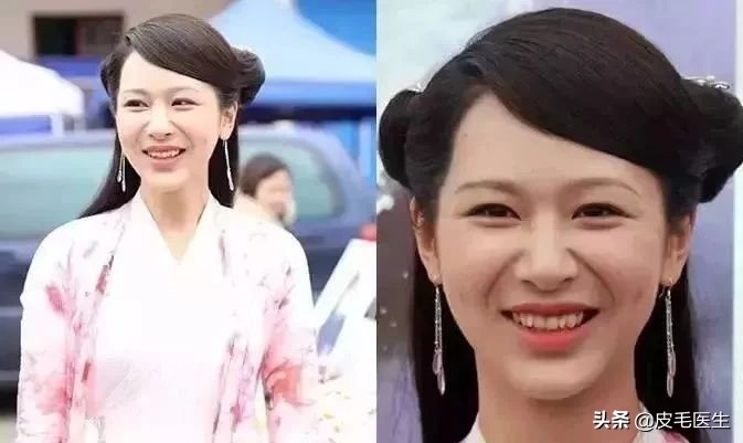 笑出法令纹！还能肆无忌惮地笑吗？正常笑！但改掉这5个习惯