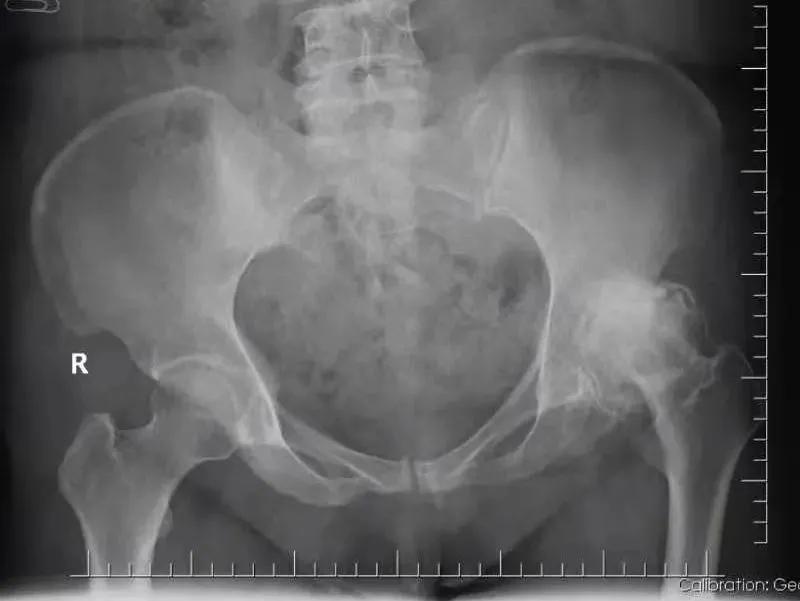 髋关节疼痛自愈的最佳方法,髋关节疼痛走路一瘸一拐