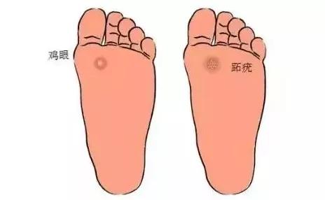 扁平疣和黑色素痣区别,疣与色素痣的区别